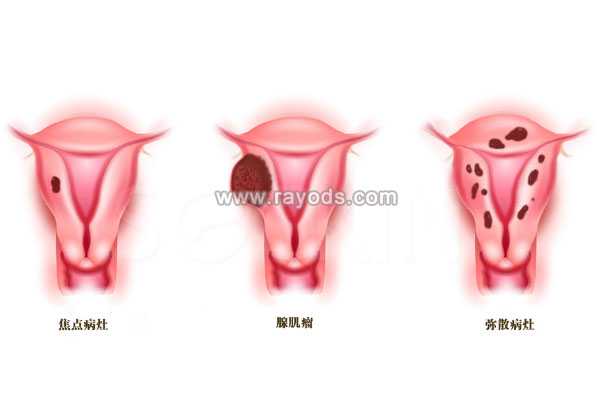 分析子宫腺肌症去泰国做试管婴儿的可行性及成功率