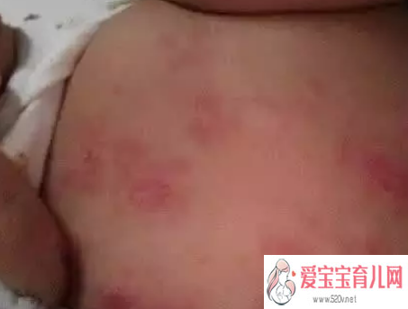 哈尔滨熟人供卵，夏天宝宝红点痱子还是湿疹夏天宝宝身上有红点原因