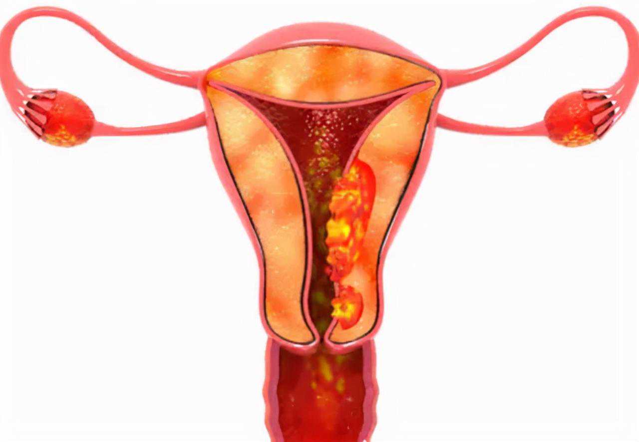 中国供卵合法吗 供卵囊胚都能成功吗 宫颈癌早期不痛不痒，一旦出现3个“异常
