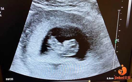深圳有捐卵，【广州供卵试管可靠吗】预产期当天出生，1.28顺产6.3斤男宝（上