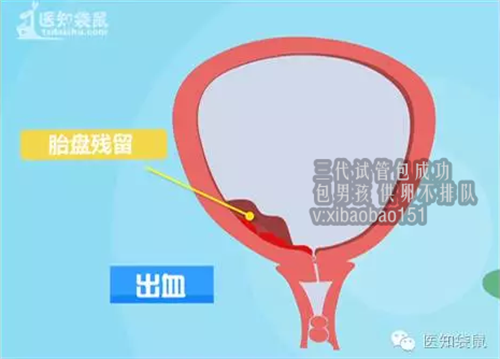 深圳助孕产子资讯,卵巢早衰怎么检查出来的